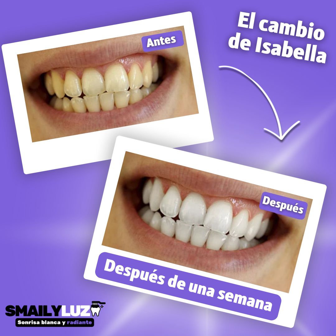 Kit blanqueador de SmailyLuz