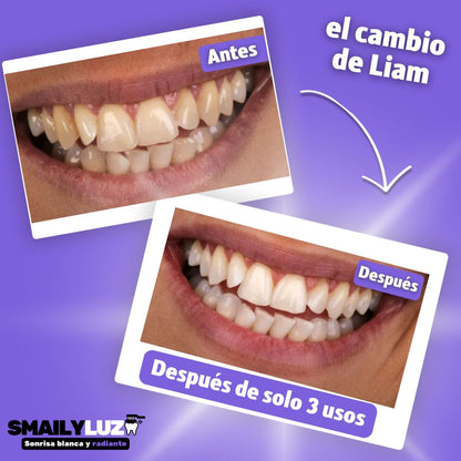 Kit blanqueador de SmailyLuz